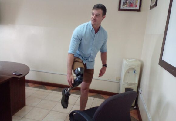 Availing Affordable Prosthetic Legs