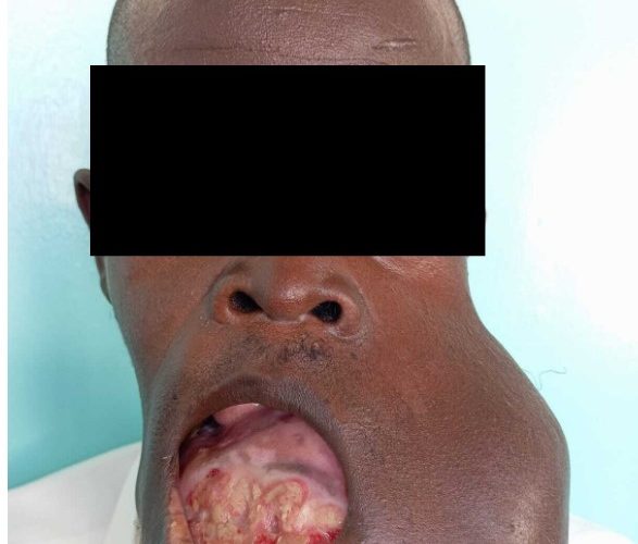 New Face, New Life: JOOTRH Maxillofacial Services Transform Patient’s Future
