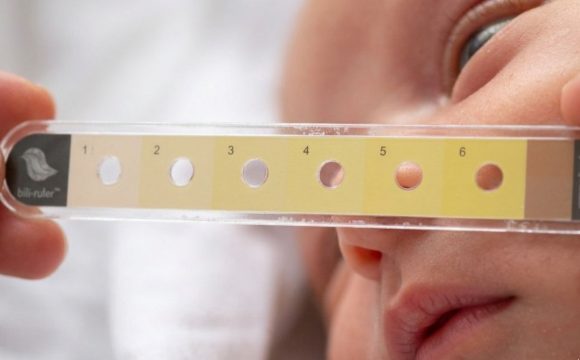 Low-Cost ‘Bili Ruler’ Revolutionizes Neonatal Jaundice Detection at JOOTRH. Low-Cost ‘Bili Ruler’ Revolutionizes Neonatal Jaundice Detection at JOOTRH.