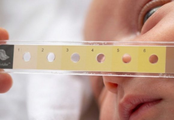 Low-Cost ‘Bili Ruler’ Revolutionizes Neonatal Jaundice Detection at JOOTRH.