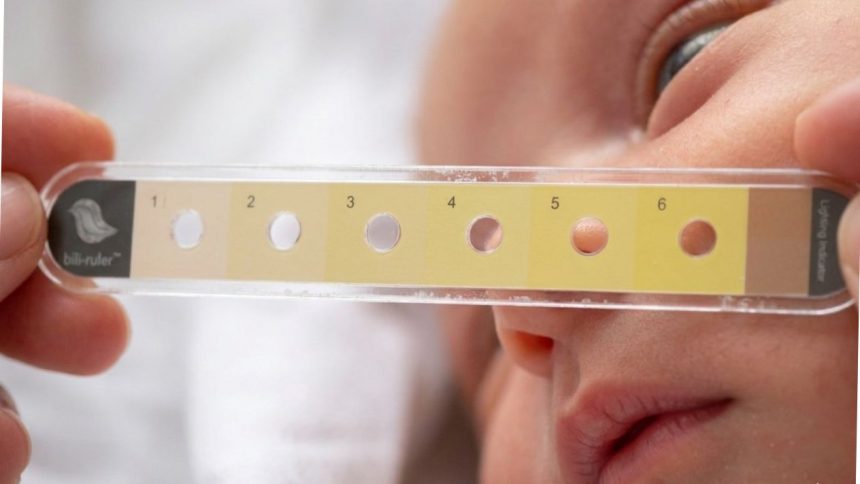 Low-Cost ‘Bili Ruler’ Revolutionizes Neonatal Jaundice Detection at JOOTRH.