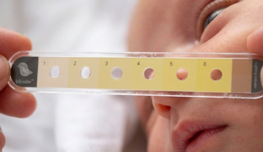 Low-Cost ‘Bili Ruler’ Revolutionizes Neonatal Jaundice Detection at JOOTRH.